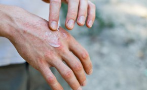 Atopický ekzém – problém kůže, který je nutný řešit zevnitř