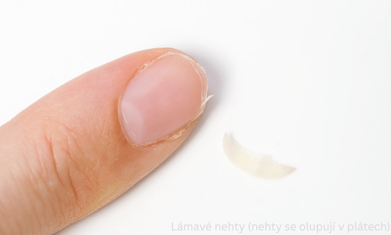 Lámavé nehty (nehty se olupují v plátech) Lámavé nehty (nehty se olupují v plátech)
