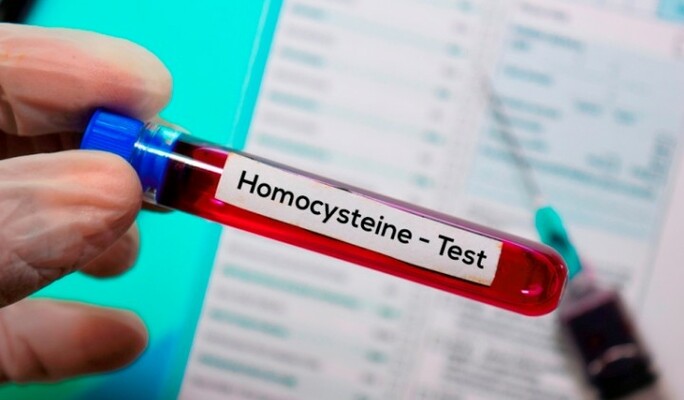 Homocystein - měřit či neměřit? Toť otázka