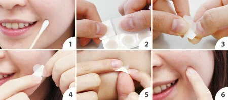 Náplasti na akné 12 ks